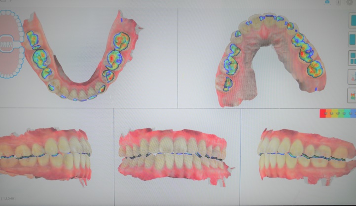 専用3Dスキャナ(iTero)から得られた口の情報から3次元治療計画